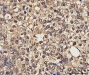 IHC staining of FFPE human ovarian cancer tissue with NELFE antibody. HIER: boil tissue sections in pH8 EDTA for 20 min and allow to cool before testing.