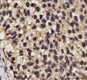 IHC staining of FFPE human lung squamous cell carcinoma tissue with NELFE antibody. HIER: boil tissue sections in pH8 EDTA for 20 min and allow to cool before testing.