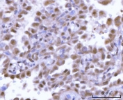 IHC staining of FFPE human lung adenocarcinoma tissue with SF3a66 antibody. HIER: boil tissue sections in pH8 EDTA for 20 min and allow to cool before testing.