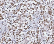 IHC staining of FFPE human testicular seminoma tissue with SF3a66 antibody. HIER: boil tissue sections in pH8 EDTA for 20 min and allow to cool before testing.