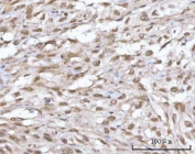 IHC staining of FFPE human urothelial carcinoma tissue with SF3a66 antibody. HIER: boil tissue sections in pH8 EDTA for 20 min and allow to cool before testing.