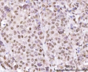 IHC staining of FFPE human liver cancer tissue with SF3a66 antibody. HIER: boil tissue sections in pH8 EDTA for 20 min and allow to cool before testing.