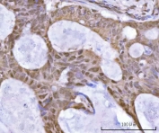 IHC staining of FFPE human rectum adenocarcinoma tissue with SF3a66 antibody. HIER: boil tissue sections in pH8 EDTA for 20 min and allow to cool before testing.