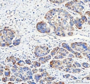 IHC staining of FFPE human laryngeal squamous cell carcinoma tissue with PAPSS2 antibody. HIER: boil tissue sections in pH8 EDTA for 20 min and allow to cool before testing.
