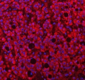 Immunofluorescent staining of FFPE human liver cancer tissue with PAPSS2 antibody (red) and DAPI nuclear stain (blue). HIER: steam section in pH8 EDTA buffer for 20 min.