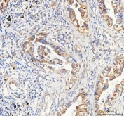 IHC staining of FFPE human lung cancer tissue with PAPSS2 antibody. HIER: boil tissue sections in pH8 EDTA for 20 min and allow to cool before testing.
