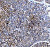 IHC staining of FFPE human liver cancer tissue with PAPSS2 antibody. HIER: boil tissue sections in pH8 EDTA for 20 min and allow to cool before testing.