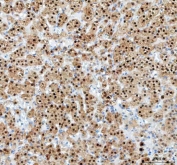 IHC staining of FFPE human adrenocortical adenoma tissue with PAPSS2 antibody. HIER: boil tissue sections in pH8 EDTA for 20 min and allow to cool before testing.