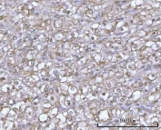 IHC staining of FFPE human glioblastoma tissue with PSMD14 antibody. HIER: boil tissue sections in pH8 EDTA for 20 min and allow to cool before testing.