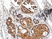 IHC staining of FFPE human human lung adenocarcinoma tissue with PSMD14 antibody. HIER: boil tissue sections in pH8 EDTA for 20 min and allow to cool before testing.