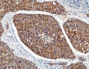 IHC staining of FFPE human liver cancer tissue with PSMD14 antibody. HIER: boil tissue sections in pH8 EDTA for 20 min and allow to cool before testing.