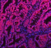 Immunofluorescent staining of FFPE human intestinal cancer tissue with SAM68 antibody (red) and DAPI nuclear stain (blue). HIER: steam section in pH8 EDTA buffer for 20 min.