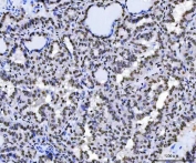 IHC staining of FFPE human papillary thyroid carcinoma tissue with SAM68 antibody. HIER: boil tissue sections in pH8 EDTA for 20 min and allow to cool before testing.