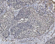 IHC staining of FFPE human ovarian adenocarcinoma tissue with SAM68 antibody. HIER: boil tissue sections in pH8 EDTA for 20 min and allow to cool before testing.