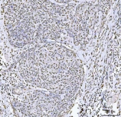 IHC staining of FFPE human keratinizing squamous cell carcinoma tissue with SAM68 antibody. HIER: boil tissue sections in pH8 EDTA for 20 min and allow to cool before testing.