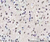 IHC staining of FFPE human glioblastoma tissue with SAM68 antibody. HIER: boil tissue sections in pH8 EDTA for 20 min and allow to cool before testing.