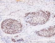 IHC staining of FFPE human esophageal squamous carcinoma tissue with RBFOX2 antibody. HIER: boil tissue sections in pH8 EDTA for 20 min and allow to cool before testing.