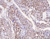 IHC staining of FFPE human liver cancer tissue with RBFOX2 antibody. HIER: boil tissue sections in pH8 EDTA for 20 min and allow to cool before testing.