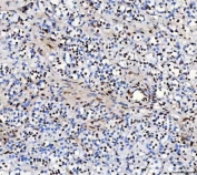 IHC staining of FFPE human cortical adenoma tissue with RBFOX2 antibody. HIER: boil tissue sections in pH8 EDTA for 20 min and allow to cool before testing.