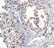 IHC staining of FFPE human lung cancer tissue with RBFOX2 antibody. HIER: boil tissue sections in pH8 EDTA for 20 min and allow to cool before testing.