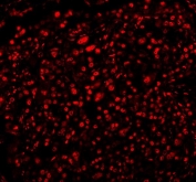 Immunofluorescent staining of FFPE human lung cancer tissue with RBFOX2 antibody (red). HIER: steam section in pH8 EDTA buffer for 20 min.