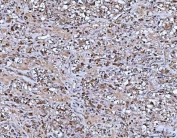 IHC staining of FFPE human glioblastoma tissue with TMS1 antibody. HIER: boil tissue sections in pH8 EDTA for 20 min and allow to cool before testing.