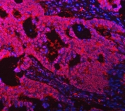 Immunofluorescent staining of FFPE human intestinal cancer tissue with TMS1 antibody (red) and DAPI nuclear stain (blue). HIER: steam section in pH8 EDTA buffer for 20 min.