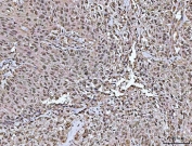 IHC staining of FFPE human urothelial carcinoma with squamous differentiation tissue with TMS1 antibody. HIER: boil tissue sections in pH8 EDTA for 20 min and allow to cool before testing.