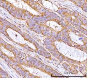 IHC staining of FFPE human rectum adenocarcinoma tissue with TRNT1 antibody. HIER: boil tissue sections in pH8 EDTA for 20 min and allow to cool before testing.