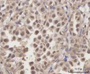 IHC staining of FFPE human lung adenocarcinoma tissue with Selenocysteine lyase antibody. HIER: boil tissue sections in pH8 EDTA for 20 min and allow to cool before testing.