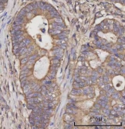 IHC staining of FFPE human rectum adenocarcinoma tissue with Selenocysteine lyase antibody. HIER: boil tissue sections in pH8 EDTA for 20 min and allow to cool before testing.
