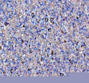 Immunohistochemical staining of FFPE human glioblastoma tissue with NECAB1 antibody, HRP-secondary and DAB substrate. HIER: boil tissue sections in pH8 EDTA for 20 min and allow to cool before testing.