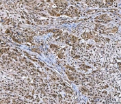 IHC staining of FFPE human esophageal squamous carcinoma tissue with GLI2 antibody. HIER: boil tissue sections in pH8 EDTA for 20 min and allow to cool before testing.