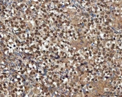 IHC staining of FFPE human testicular germ cell tumor tissue with GLI2 antibody. HIER: boil tissue sections in pH8 EDTA for 20 min and allow to cool before testing.