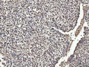 IHC staining of FFPE human breast cancer tissue with NUMA1 antibody. HIER: boil tissue sections in pH8 EDTA for 20 min and allow to cool before testing.