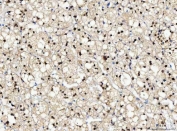 IHC staining of FFPE human adrenal adenoma tissue with NUB1 antibody. HIER: boil tissue sections in pH8 EDTA for 20 min and allow to cool before testing.