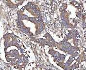IHC staining of FFPE human colorectal adenocarcinoma tissue with TANGO1 antibody. HIER: boil tissue sections in pH8 EDTA for 20 min and allow to cool before testing.