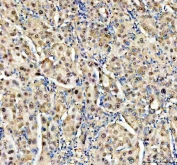 IHC staining of FFPE human liver cancer tissue with NUDT5 antibody. HIER: boil tissue sections in pH8 EDTA for 20 min and allow to cool before testing.