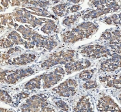 IHC staining of FFPE human liver cancer tissue with MYDGF antibody. HIER: boil tissue sections in pH8 EDTA for 20 min and allow to cool before testing.