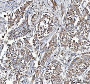 IHC staining of FFPE human lung cancer tissue with MYDGF antibody. HIER: boil tissue sections in pH8 EDTA for 20 min and allow to cool before testing.