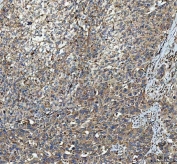 IHC staining of FFPE human bladder urothelial carcinoma tissue with MYDGF antibody. HIER: boil tissue sections in pH8 EDTA for 20 min and allow to cool before testing.