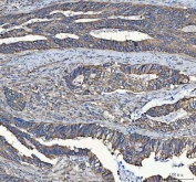 IHC staining of FFPE human colorectal adenocarcinoma tissue with MYDGF antibody. HIER: boil tissue sections in pH8 EDTA for 20 min and allow to cool before testing.