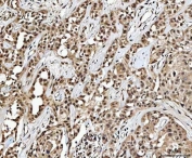 IHC staining of FFPE human parotid acinar cell carcinoma tissue with MED26 antibody. HIER: boil tissue sections in pH8 EDTA for 20 min and allow to cool before testing.