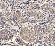 IHC staining of FFPE human liver cancer tissue with MED26 antibody. HIER: boil tissue sections in pH8 EDTA for 20 min and allow to cool before testing.
