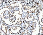 IHC staining of FFPE human thyroid cancer tissue with MGME1 antibody. HIER: boil tissue sections in pH8 EDTA for 20 min and allow to cool before testing.