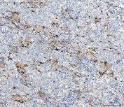IHC staining of FFPE human testicular germ cell tumor tissue with MGME1 antibody. HIER: boil tissue sections in pH8 EDTA for 20 min and allow to cool before testing.