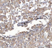 IHC staining of FFPE human lung cancer tissue with MLEC antibody. HIER: boil tissue sections in pH8 EDTA for 20 min and allow to cool before testing.