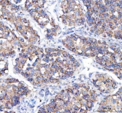 IHC staining of FFPE human liver cancer tissue with MLEC antibody. HIER: boil tissue sections in pH8 EDTA for 20 min and allow to cool before testing.