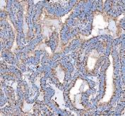 IHC staining of FFPE human thyroid cancer tissue with MLEC antibody. HIER: boil tissue sections in pH8 EDTA for 20 min and allow to cool before testing.