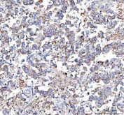 IHC staining of FFPE human testicular germ cell tumor tissue with MLEC antibody. HIER: boil tissue sections in pH8 EDTA for 20 min and allow to cool before testing.